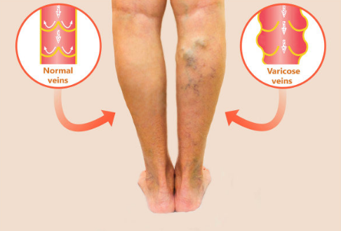 下肢静脉曲张可遗传,小信号别忽略